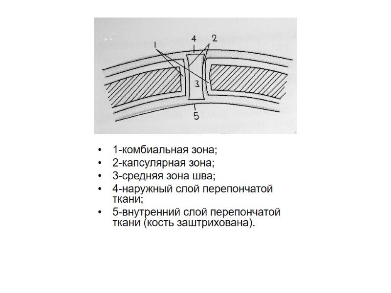 1-комбиальная зона; 2-капсулярная зона; 3-средняя зона шва; 4-наружный слой перепончатой ткани; 5-внутренний слой перепончатой